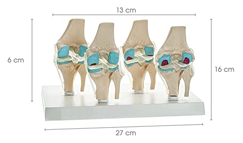 Spancare 4 Stage Osteoarthritis Anatomical Knee Model, Model On Base, with Detailed Study