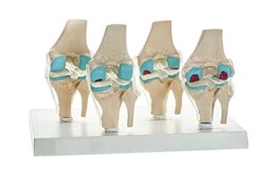spancare 4 stage osteoarthritis anatomical knee model, model on base, with detailed study