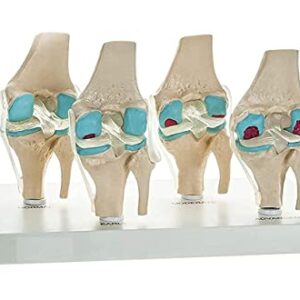 Spancare 4 Stage Osteoarthritis Anatomical Knee Model, Model On Base, with Detailed Study