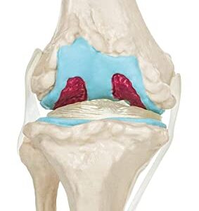 Spancare 4 Stage Osteoarthritis Anatomical Knee Model, Model On Base, with Detailed Study