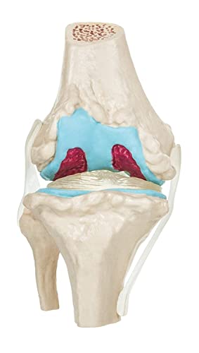 Spancare 4 Stage Osteoarthritis Anatomical Knee Model, Model On Base, with Detailed Study