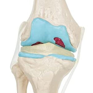 Spancare 4 Stage Osteoarthritis Anatomical Knee Model, Model On Base, with Detailed Study