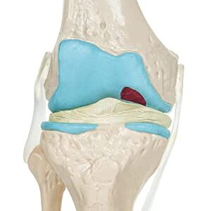 Spancare 4 Stage Osteoarthritis Anatomical Knee Model, Model On Base, with Detailed Study