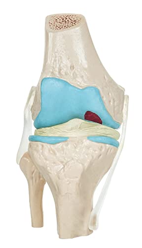 Spancare 4 Stage Osteoarthritis Anatomical Knee Model, Model On Base, with Detailed Study