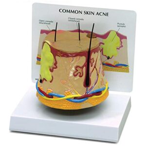 gpi anatomicals - skin acne model, cylindrical model showing normal and common acne-riddled skin for human anatomy and physiology education, anatomy model for doctor's office, medical study supplies