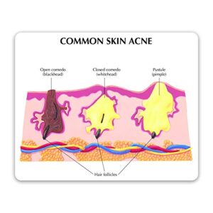 GPI Anatomicals - Skin Acne Model, Cylindrical Model Showing Normal and Common Acne-Riddled Skin for Human Anatomy and Physiology Education, Anatomy Model for Doctor's Office, Medical Study Supplies