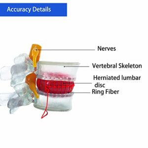 Veipho Human Anatomical Lumbar Disc Herniation Model, Transparency Lumbar Disc Herniation Model, Lumbar Disc Model for Teaching and Demonstrating