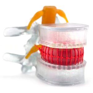 DenFactory Human 1.5 Times Life-Size Transparent Lumbar Disc Herniation Spine Model for Teaching and Learning