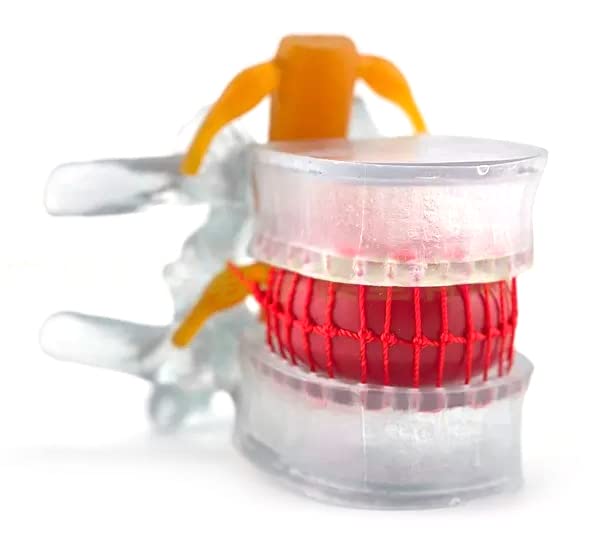 DenFactory Human 1.5 Times Life-Size Transparent Lumbar Disc Herniation Spine Model for Teaching and Learning