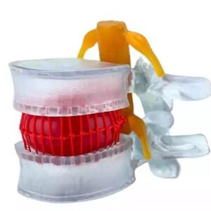 DenFactory Human 1.5 Times Life-Size Transparent Lumbar Disc Herniation Spine Model for Teaching and Learning