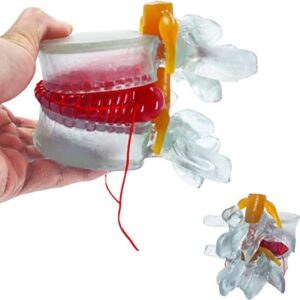 DenFactory Human 1.5 Times Life-Size Transparent Lumbar Disc Herniation Spine Model for Teaching and Learning