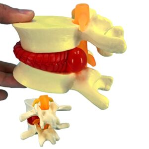 veipho human anatomical lumbar disc herniation model, 1.5 times life size lumbar disc herniation model, human lumbar disc herniation model for teaching, learning, demonstrating
