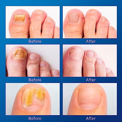 Toenail Fungus Treatment Extra Strength - Nail Fungus Treatment For Toenail, Toe Nail Fungus Treatment Extra Strength, Nighttime Fungal Nail Patches & Fungus Nail Treatment Liquid Set (21patches+15ml)