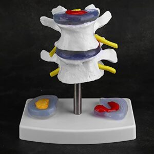 YUYTE Human Spine Model, Human Anatomical Lumbar Disc Herniation Model Human Spine School Training Supplies Excellent Way for Demonstrating Disc, Restore The Details of The Human Spine