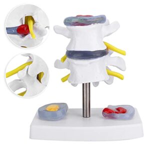 YUYTE Human Spine Model, Human Anatomical Lumbar Disc Herniation Model Human Spine School Training Supplies Excellent Way for Demonstrating Disc, Restore The Details of The Human Spine