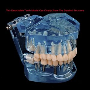 Dental Implant Model Teeth Typodont Model Dental Implant Restoration Training Tooth Pathologies Disease Demonstration Removable Teeth Teaching Studying