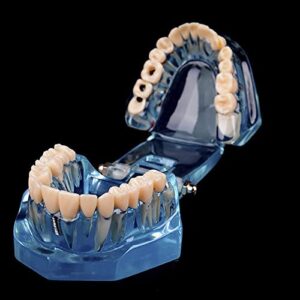 Dental Implant Model Teeth Typodont Model Dental Implant Restoration Training Tooth Pathologies Disease Demonstration Removable Teeth Teaching Studying