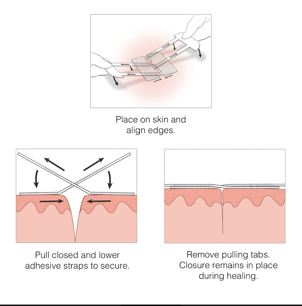 Clozex Emergency Laceration Closures - Repair Wounds Without Stitches. FDA Cleared Skin Closure Device for 3 Individual Wounds Or Combine for Total Length of 4 1/4 Inches.