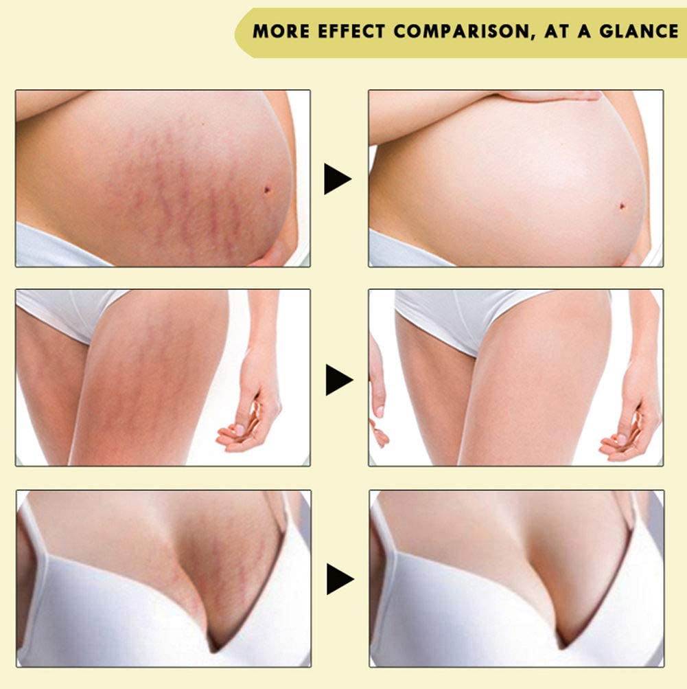 Rose Remove Stretch Marks Cream for Pregnancy Scar Removal Cream Natural Plant Essence Formula Prevention Remove Stretch Mark Old Scars Body Moisturizer 40g