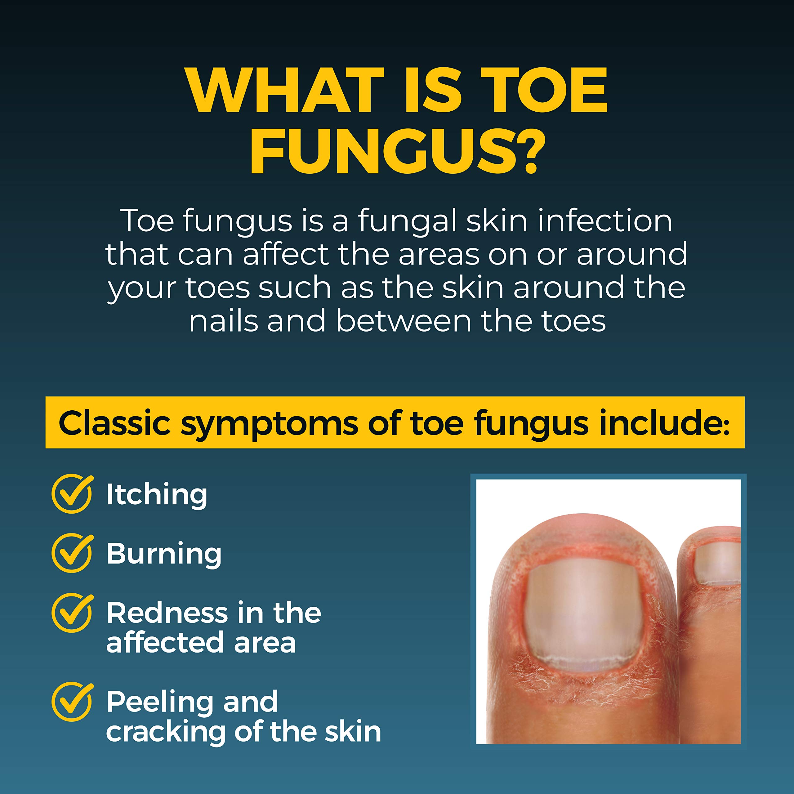 Fungi-Nail Anti-Fungal Liquid Solution, Kills Fungus That Can Lead to Nail & Athlete’s Foot with Tolnaftate & Clinically Proven to Cure and Prevent Fungal Infections 1 Fl Oz (Pack of 2)