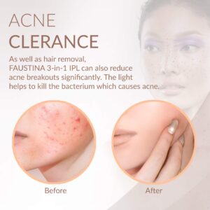 FAUSTINA 3-in-1 IPL (3 Lamps 1,500,000 Shots) Hair Removal, Skin Rejuvenation, and Acne Clearance Device - Completely Painless - Full Results After 3-7 Treatments - Free Pouch & Sunglasses.