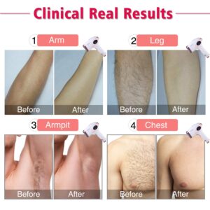 Permanent Hair Removal for Women & Men, IMENE 500,000 Flashes IPL Permanent Hair Removal & Upgrade Ice Compress - Home Use Hair Remover on Bikini line, Legs, Arms, Armpits - More Safe and Comfortable