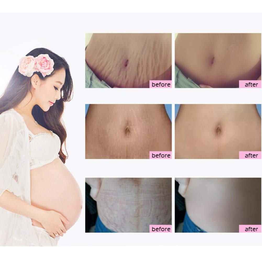 6pcs Scars Removal Cream, Mango Remove Pregnancy Scars Cream Stretches Marks Treatment Maternity Repair Firming Skin