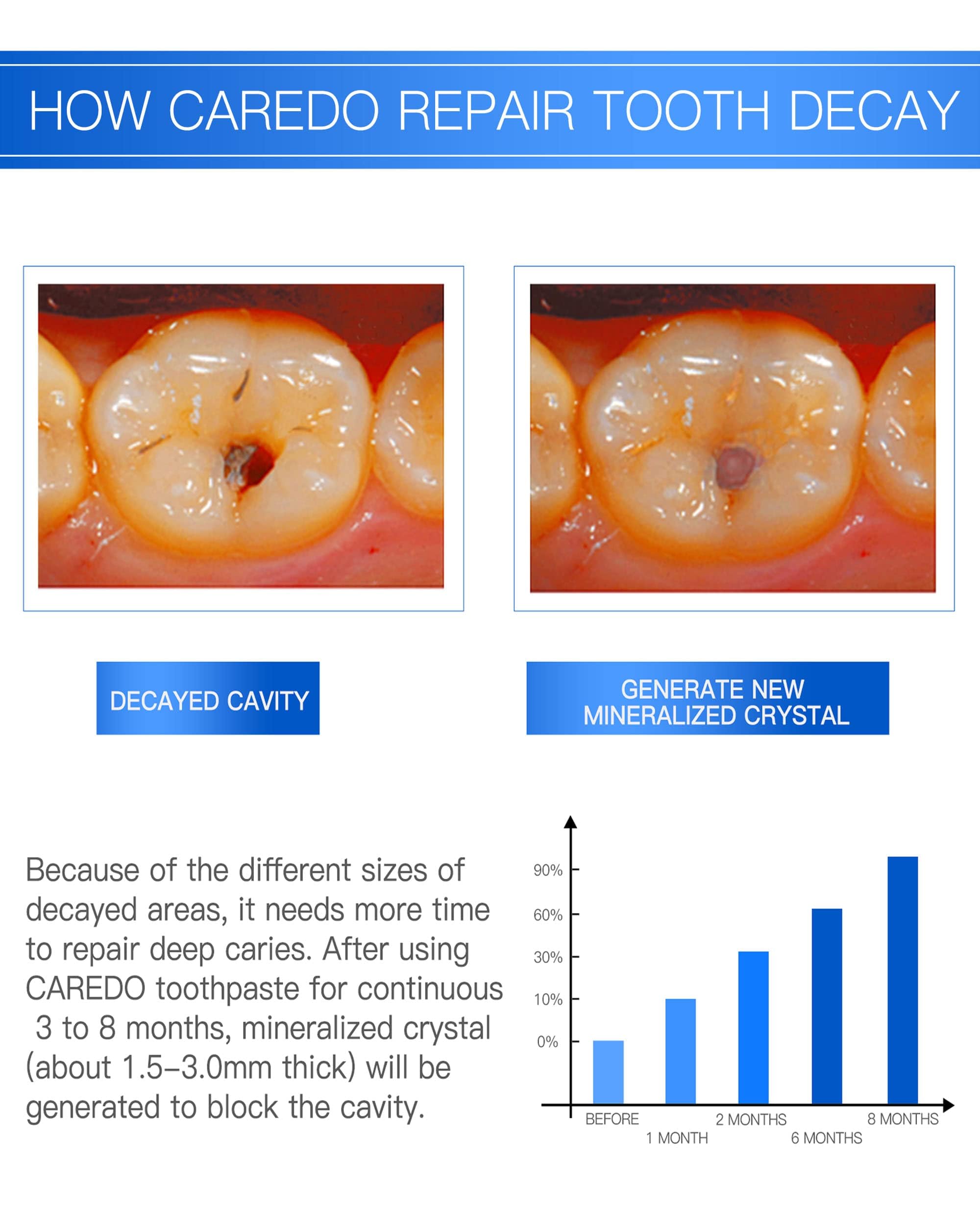 CAREDO Cavity Repair Toothpaste Set for Adults, 16g Pulpitis Ointment for Tooth Decay Pain Repair & 100g Hydroxyapatite Toothpaste for Home Cavity Repair, Cavity Tooth Repair Fluoride Free Toothpaste