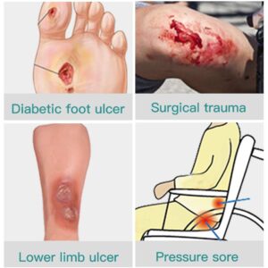 Dimora Calcium Alginate Wound Dressing & Super Absorbent Wound Dressing