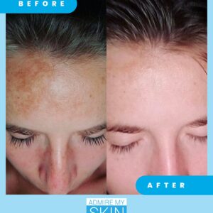 Admire My Skin Dark Spot Corrector Remover for Face - Brightening Discoloration Correcting Serum - Kojic Acid + Azelaic Acid Serum for Melasma and Sun Spots 1oz