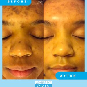 Admire My Skin Dark Spot Corrector Remover for Face - Brightening Discoloration Correcting Serum - Kojic Acid + Azelaic Acid Serum for Melasma and Sun Spots 1oz