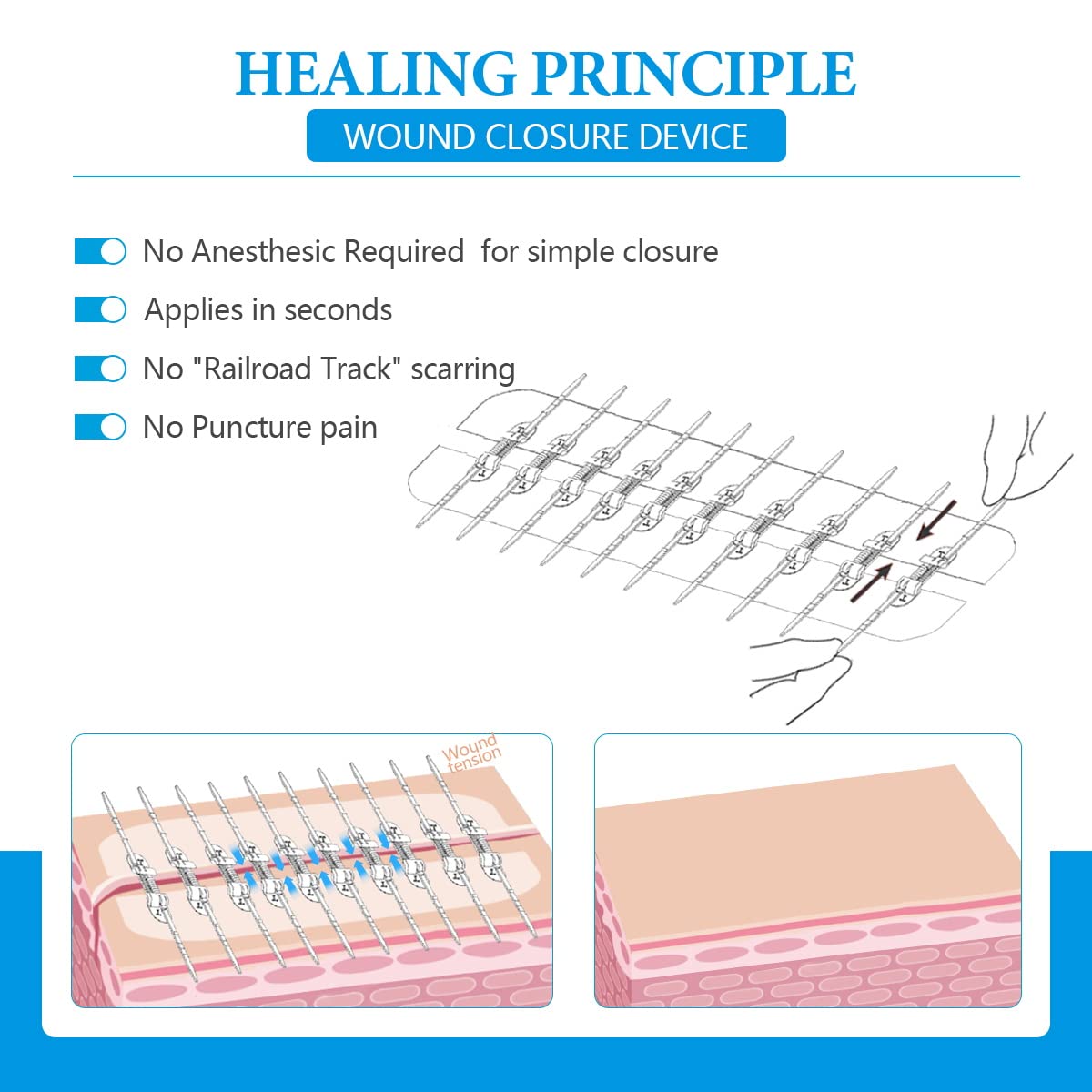 Large Butterfly Bandaids, Steri Strips Wound Closure, Emergency Wound Closure Device Surgical Laceration Repair without Stitches for Extra Large Wound Care, Ahead Be Prepared (PU)