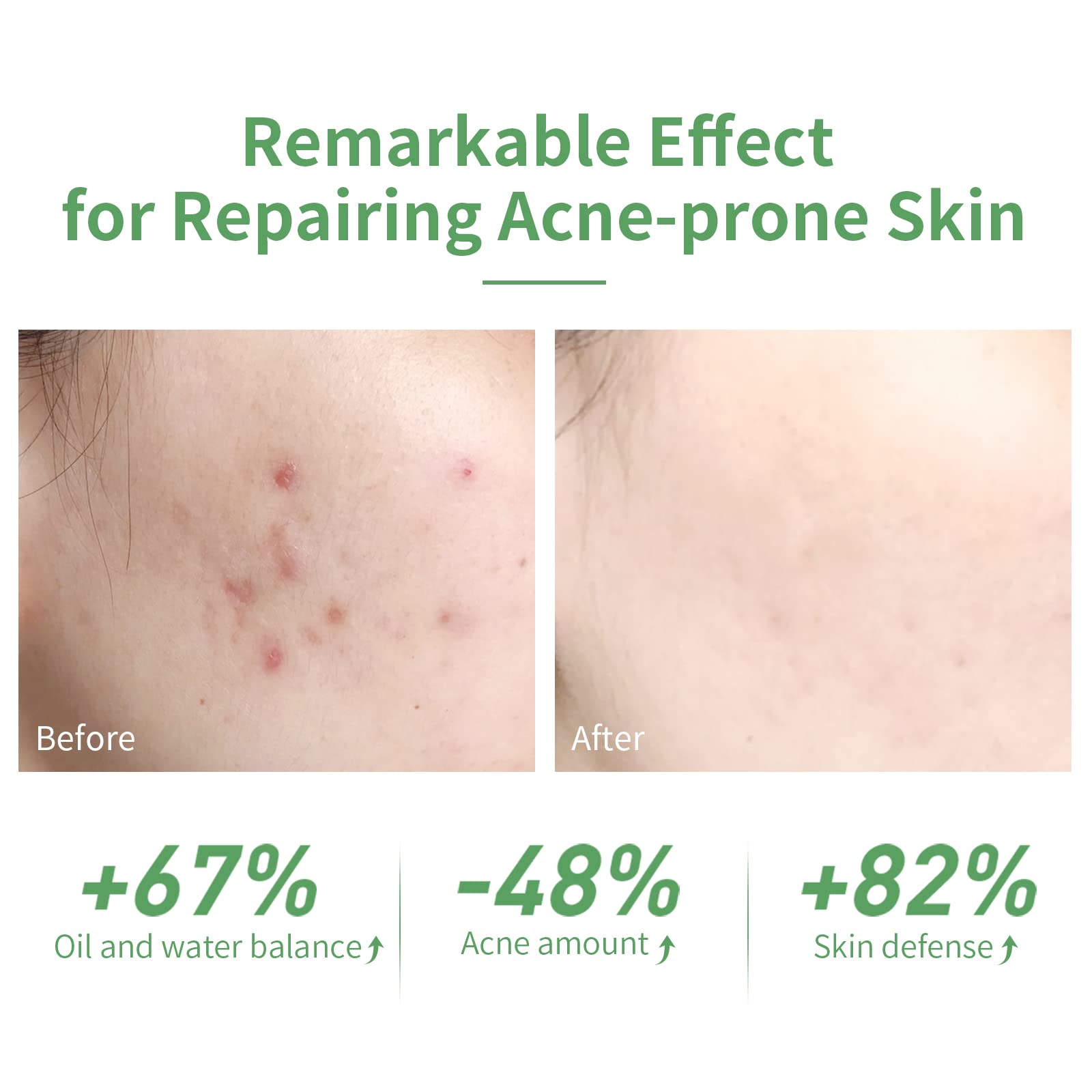 Acne Treatment Face Serum, 10% Salicylic Acid, Pimples Remover & Dead Skin Peels, Relieve Redness Rosacea Blemish, Centella Asiatica Soothing Calming, Acne Prone Sensitive Facial Skin Care, 30ml