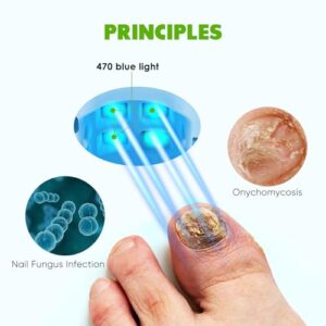 Nail Fungus Light for Toenails, FSA or HSA eligible Highly Effective Blue Light to Defeat Onychomycosis, Revolutionary Nail Fungus Solution Easy to Use at Home, Elderly