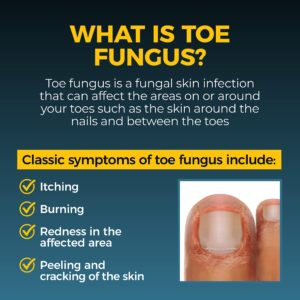 Fungi-Nail Pen Applicator Anti-Fungal Solution, Kills Fungus That Can Lead to Nail & Athlete’s Foot with Tolnaftate & Clinically Proven to Cure and Prevent Fungal Infections, 0.101 Fl Oz (Pack of 1)