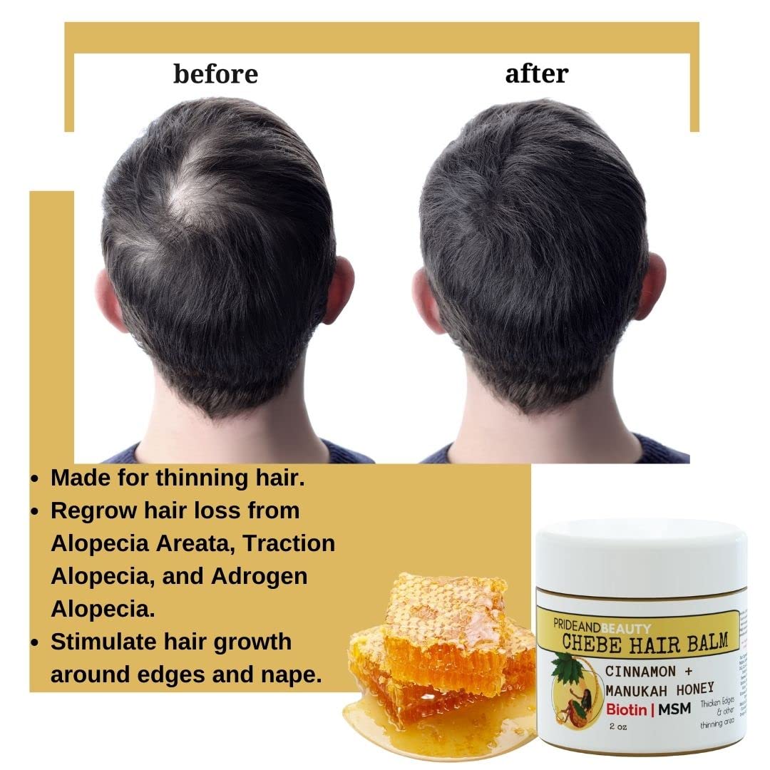 Chebe Butter For Hair Growth. Manuka Honey (Biotin+MSM)| Alopecia Growth Stimulant | Great For Balding/Bald Spots. Chebe Hair Butter, With Chebe Powder. (Chebe Hair Balm)