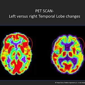 "Understanding Frontotemporal Dementias (FTDs)" 2-DVD Set with Dementia Trainer Teepa Snow