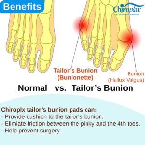 Chiroplax Tailor's Bunion Corrector Pads Bunionette Pain Relief Pinky Little Toe Straightener Separator Cushion Splint Protector Shield Spacer Cover Guard (4 Pads, Shims -Small)