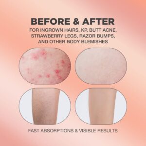 Ingrown Hair Pads | Ingrown Hair Pads with Body Exfoliating Serum for Ingrown Hairs, Strawberry Legs, Butt Acne and Razor Bumps | Ingrown Hair Pads with BHA Exfoliant | Glycolic Acid Pads | 60 Pads