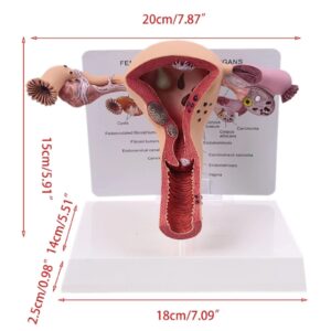 Uterus and Ovary Model, Human Anatomical Model Pathological Female Reproductive Organ Model for School Teaching Demonstration, Educational Tool