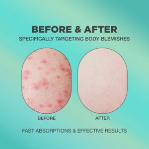 Butt Acne Cream | Butt Acne Cream for Body Blemishes | Butt Acne Cream Formulated with Natural Formula | Butt Acne Clearing Treatment Lotion | Butt Acne Spot Cream Targeting Stubborn Blemishes