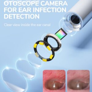 ScopeAround Otoscope Ear Camera, Ear Wax Removal Tool 1080p FHD Video Otoscope, 3.9mm Ear Wax Removal Camera with 6 LED Lights Visual Ear Scope, Compatible with iPhone15 & Android