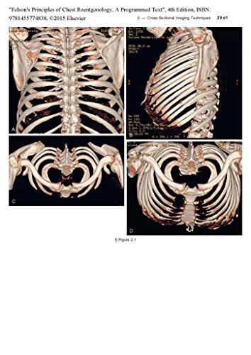 Felson's Principles of Chest Roentgenology, A Programmed Text (Goodman, Felson's Principles of Chest Roentgenology)