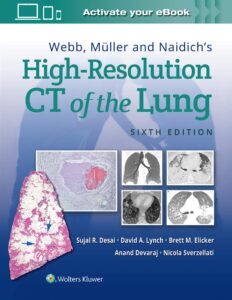 webb, müller and naidich's high-resolution ct of the lung